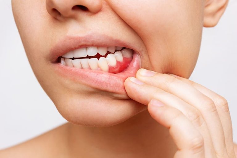 inflamacao-da-gengiva-foto-recortada-de-uma-jovem-mostrando-gengivas-sangrando-vermelhas (1)